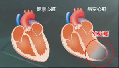 健康心脏和病变心脏对比图片
